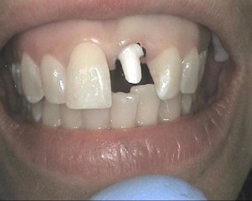 Casestudy MIssing Tooth