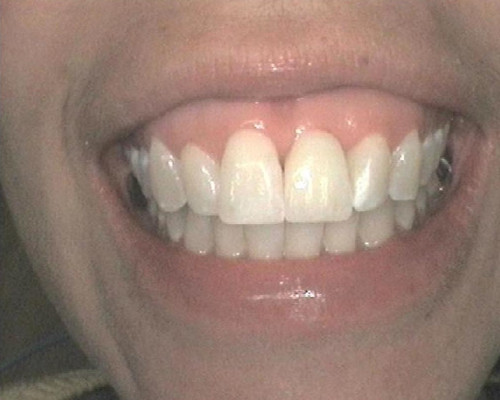 DW Casestudy Missing Tooth