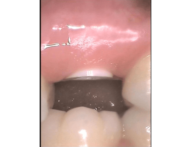 Replacing Failed Root Canal