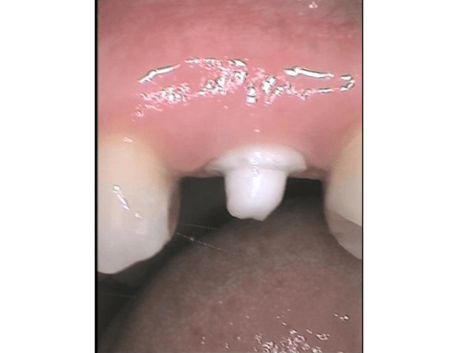 Replacing Failed Root Canal