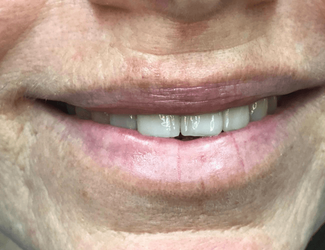 Front Tooth Replacement