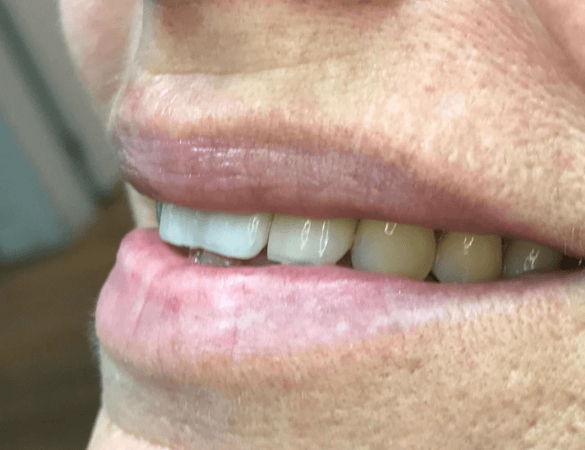 Front Tooth Replacement