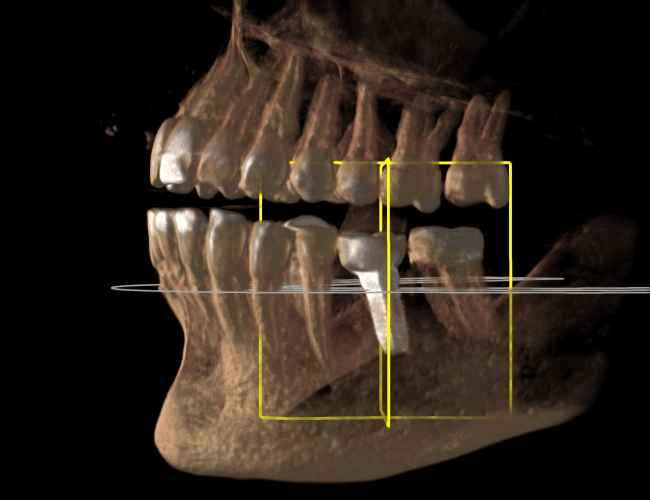Replacing Root Canal Molar with Zirconia