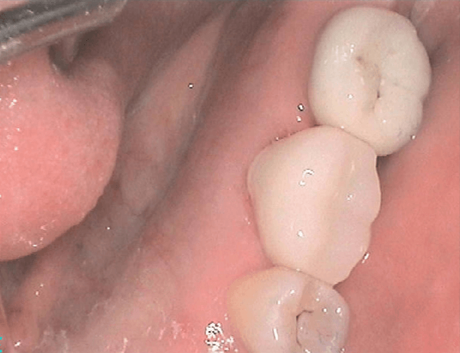Replacing Root Canal Molar with Zirconia