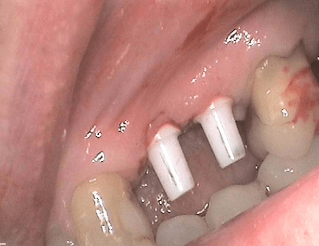 Replace Side Chewing Teeth