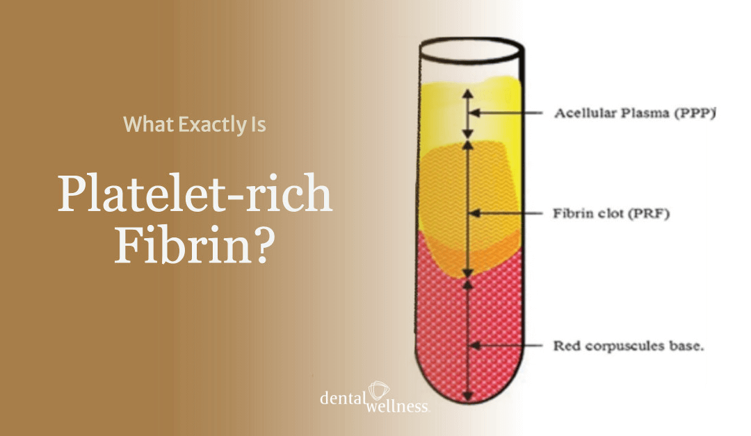 What Exactly Is Platelet-rich Fibrin?