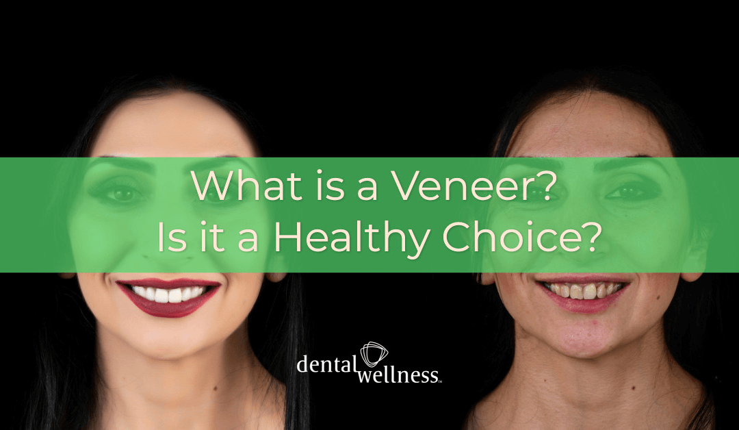 What is a Veneer? Is it a Healthy Choice?
