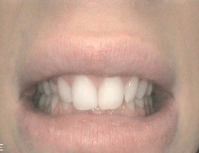 Case Study Restoring Beautiful Smile Pre Situation