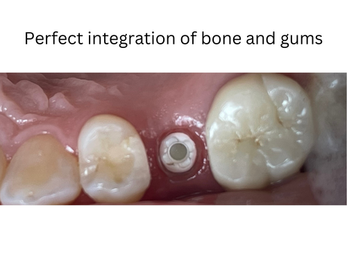 Perfect integration of bone and gums