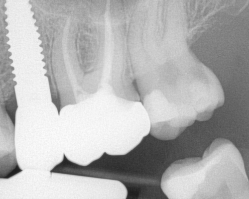 Before extraction and Zeramex Implant replacement